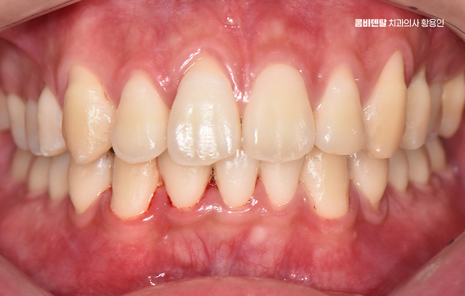 Can Crooked Lower Teeth Be Improved Without Extraction? image 7