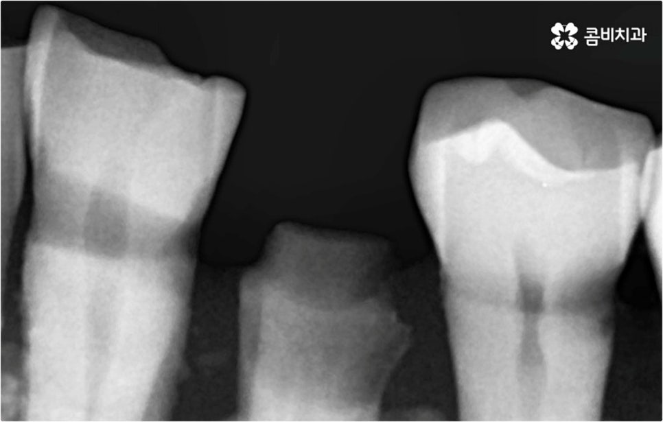 전악임플란트 고려할 사항들은 관련 이미지 7