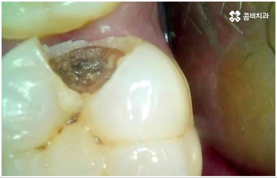 치아사이충치 놔두면 안돼요 관련 이미지 9