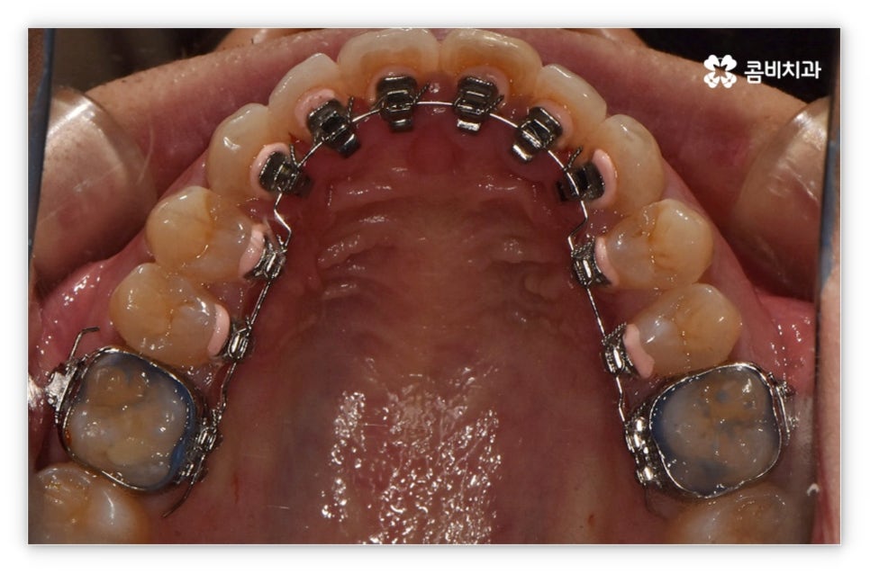 앞니설측교정 망설여질때는 관련 이미지 10