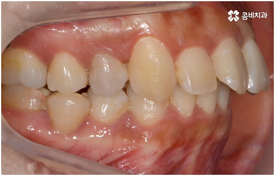 돌출치아교정 언제가 좋을까요 관련 이미지 5