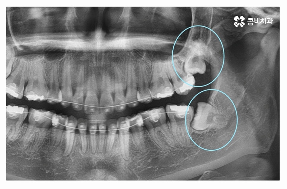 누운사랑니발치 언제 뽑을지 고민이라면 관련 이미지 2