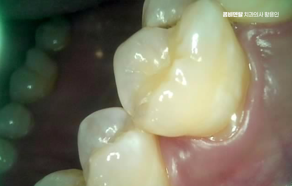 충치 검은점 나타났다면 이렇게 대처해요 관련 이미지 4