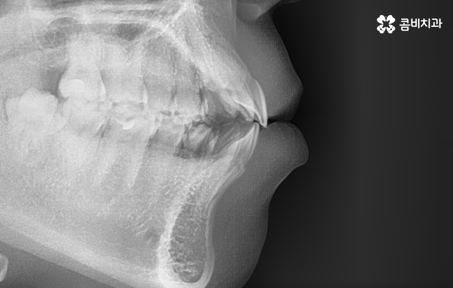 돌출입발치교정 기대해봐도 될까요 관련 이미지 5