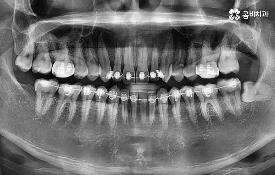 사랑니 발치 시기 이럴때 시작하면 좋아요 관련 이미지 1