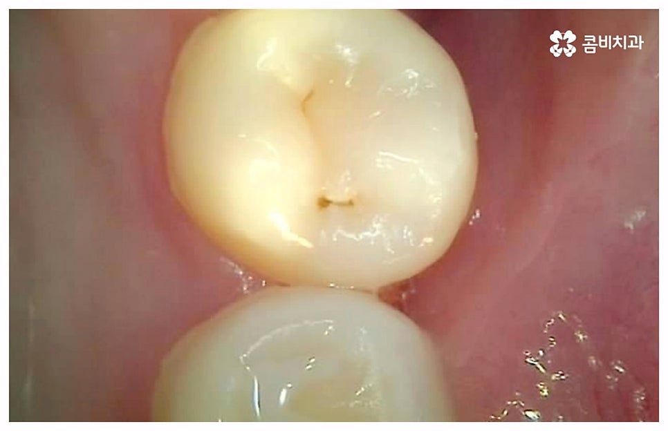 치통이 심할때 어떻게 해야하나요 관련 이미지 3