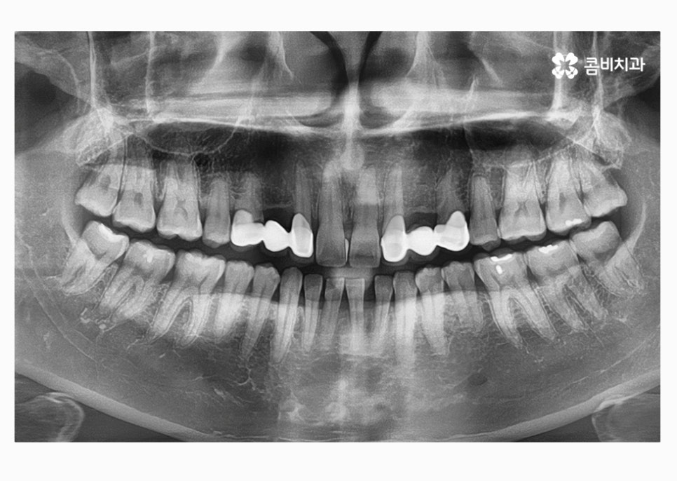 30대임플란트 향후 미래를 바라본다면 관련 이미지 4