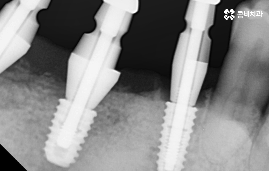 노인임플란트 이것만큼은 기억하세요 관련 이미지 6
