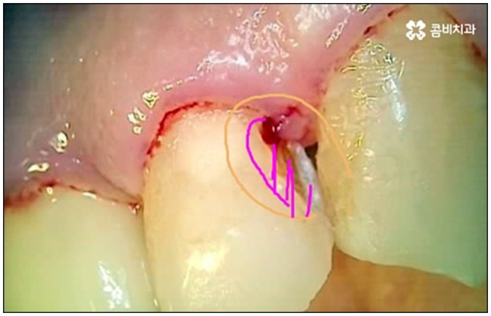 당일임플란트 나도 할수있나요 관련 이미지 5