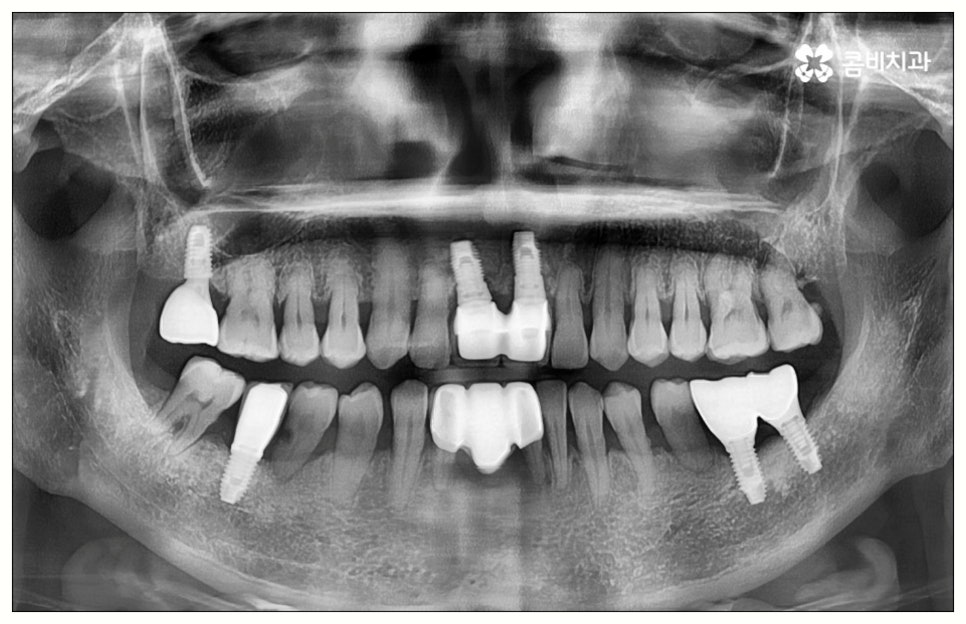원데이임플란트 어떤가요? 관련 이미지 10
