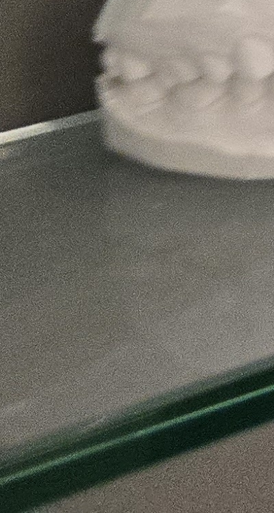 사랑니 주변 잇몸 통증 지금부터가 중요하니까 관련 이미지 43