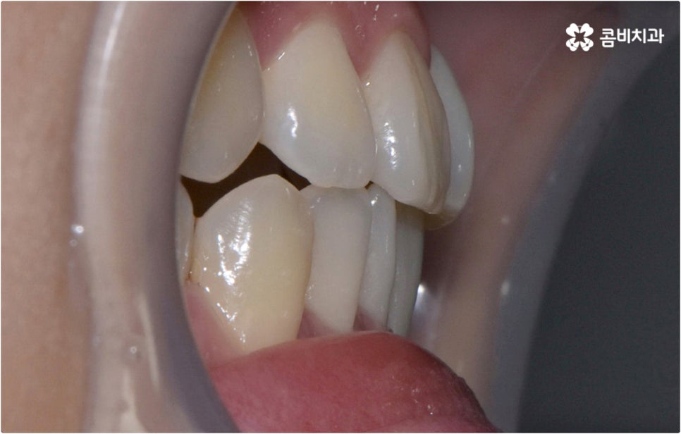 치아설측교정 보이지않아 좋아요 관련 이미지 4