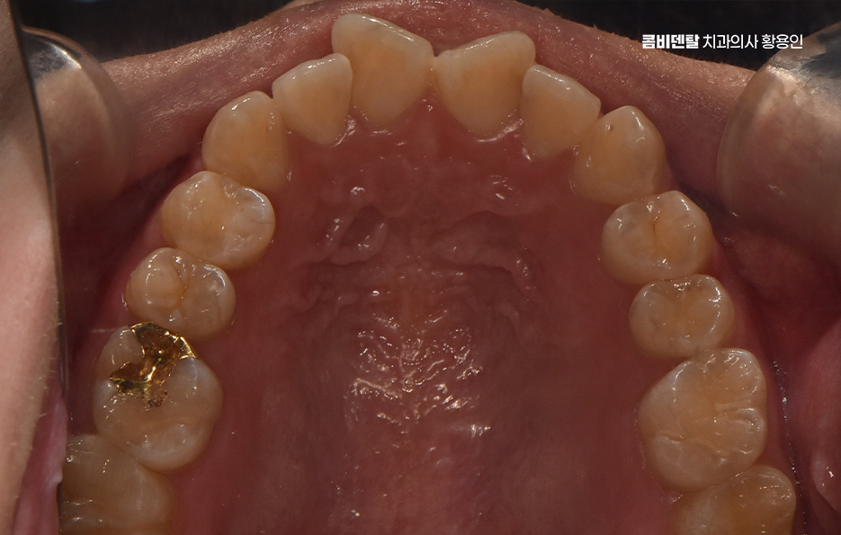 How Can You Determine the Duration of Front Teeth Orthodontic Treatment? image 6