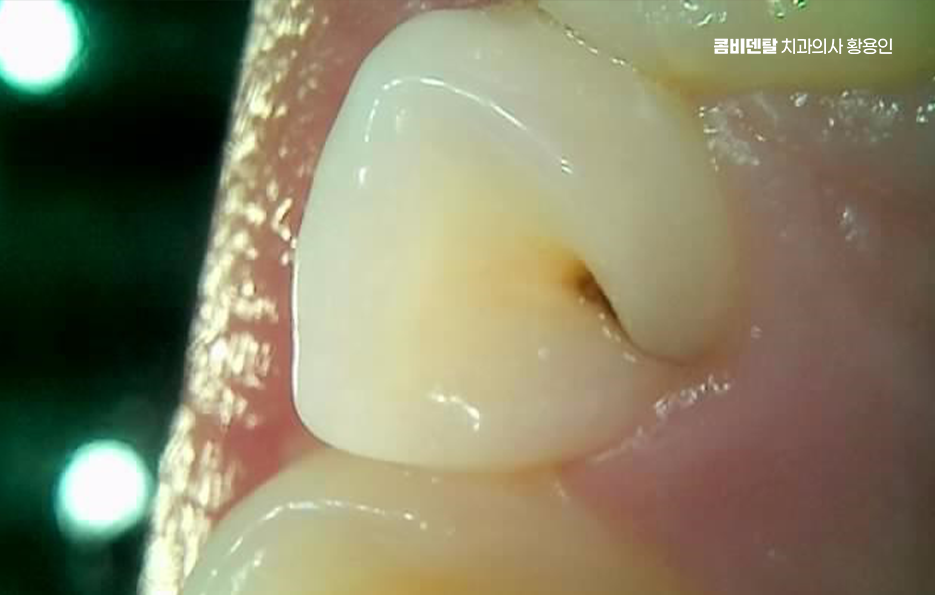 충치치료 아픈가요 미리 알고 예상하려면 관련 이미지 4