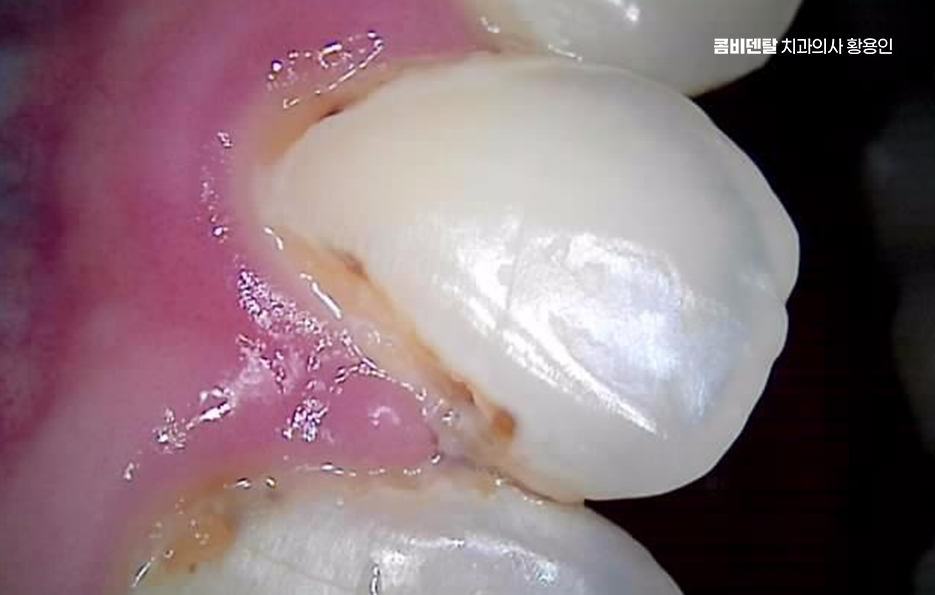 치아 시림 통증 갈수록 심해지다면 관련 이미지 5