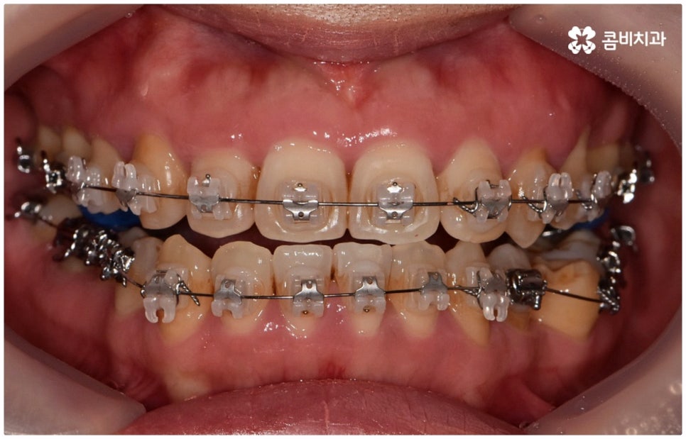 반대교합교정 늦지 않았어요 관련 이미지 6