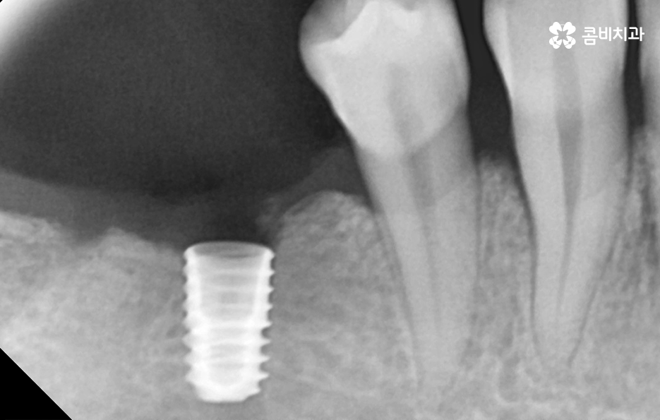 40대임플란트 치과에 이건 알고 가세요 관련 이미지 3