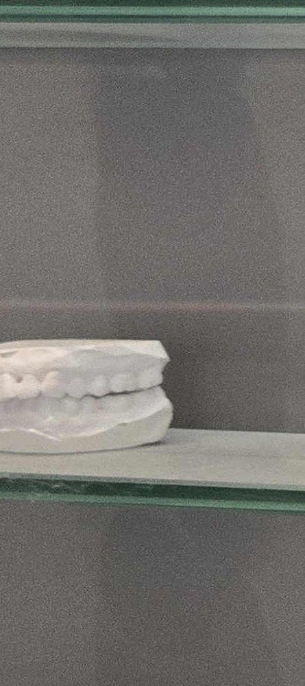 앞이빨 임플란트 과정 주의해야할 포인트는 관련 이미지 20