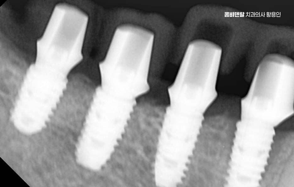 임플란트 뼈이식 안하면 어떤 문제가 있는거죠 관련 이미지 10