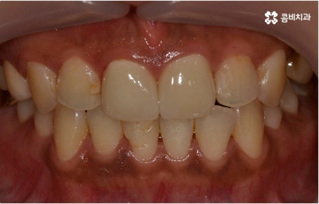 명동치과 타고난 이의 수명은 관련 이미지 3