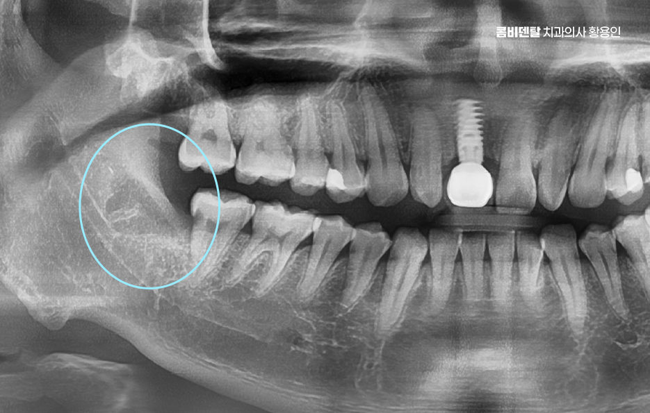 사랑니 발치 후 충치 치료 둘다 준비하려면 관련 이미지 9