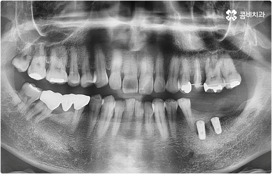 20대임플란트 남의일이 아니라면 관련 이미지 4