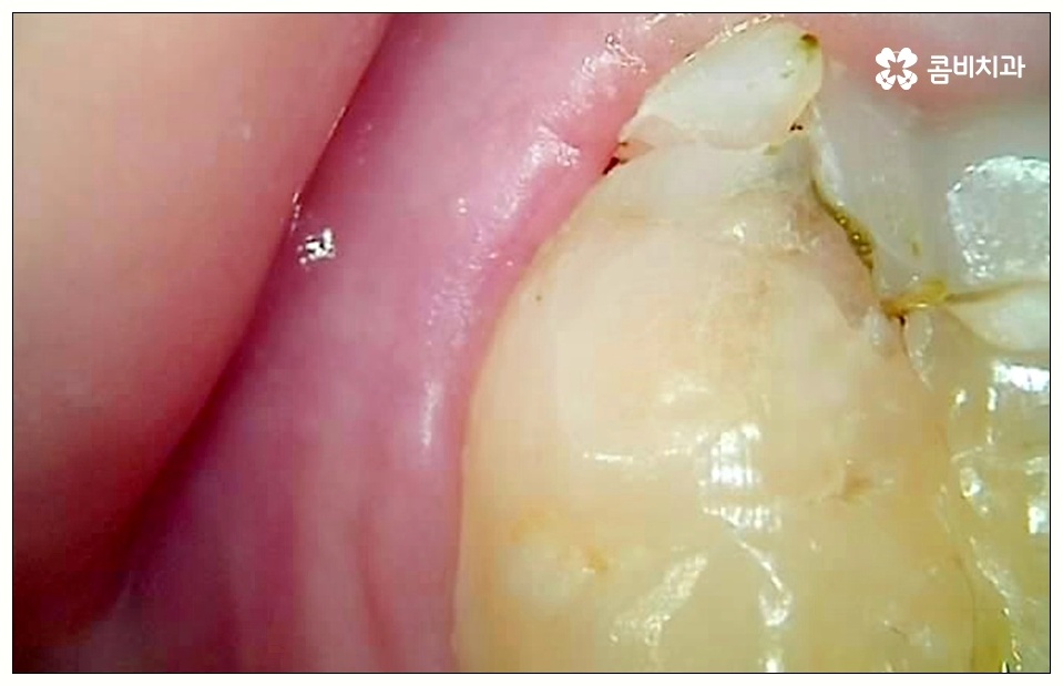어금니 사이 충치 빠르게 대응해야 관련 이미지 4