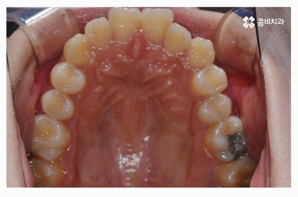 덧니교정 정교하게 따져보려면 관련 이미지 4