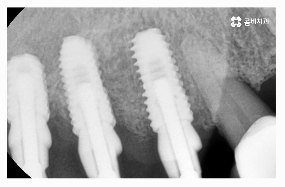 전체임플란트 신중하게 결정하려면 관련 이미지 4