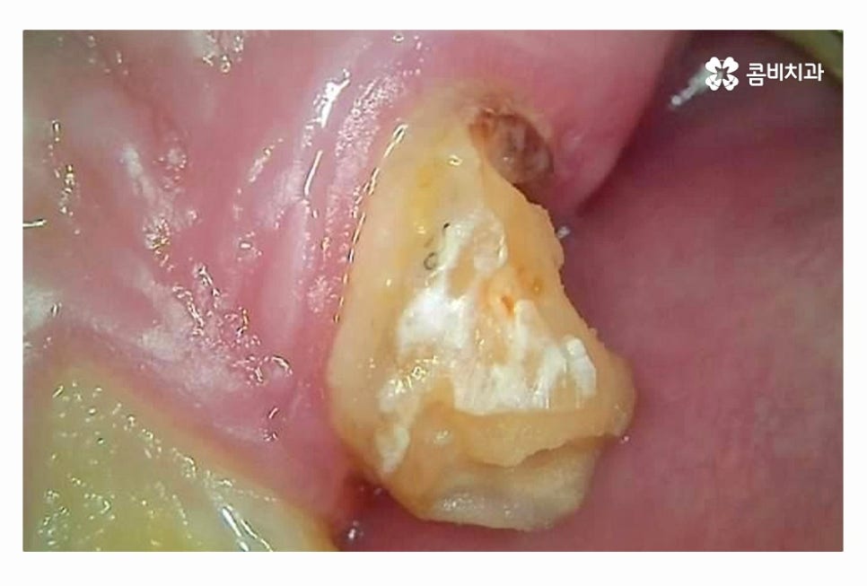 20대임플란트 갈수록 늘어나는 이유는 관련 이미지 6