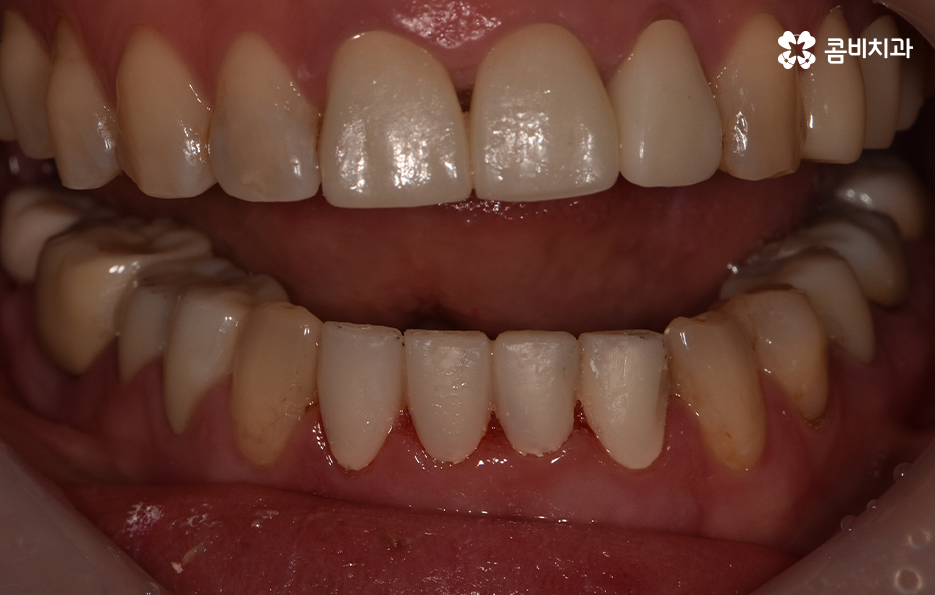 아래 앞니깨짐 치료 감쪽같이 해결하려면 관련 이미지 6
