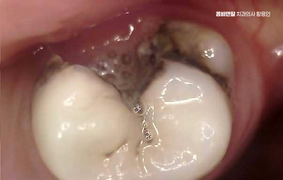 신경치료 아픈가요 망설이시는 분들이라면 관련 이미지 4