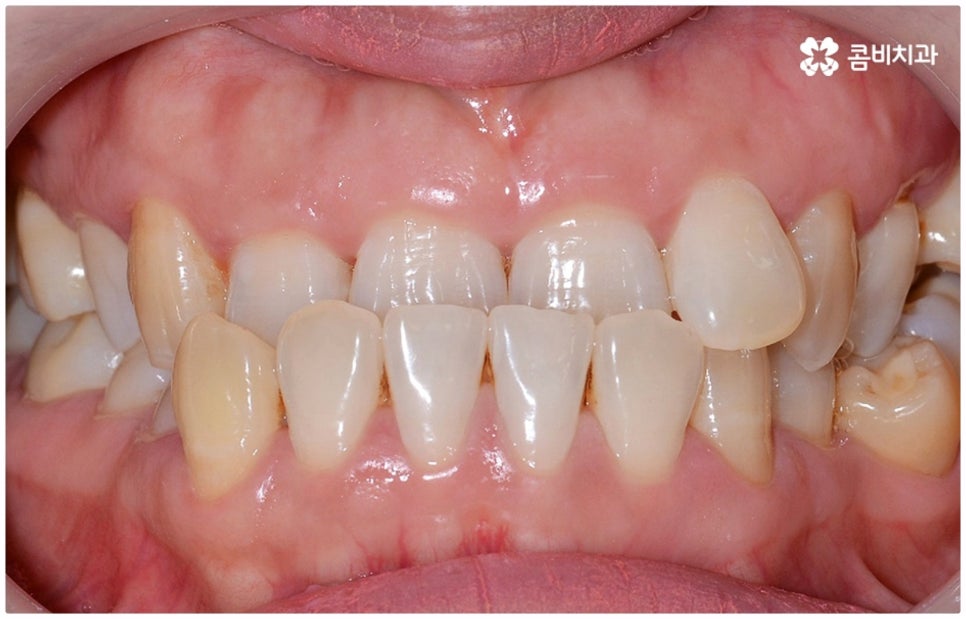 반대교합교정 늦지 않았어요 관련 이미지 3