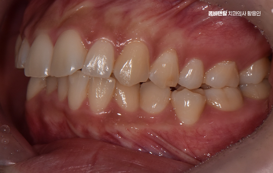 앞니 틀어짐 교정 이렇게 파악하세요 관련 이미지 5