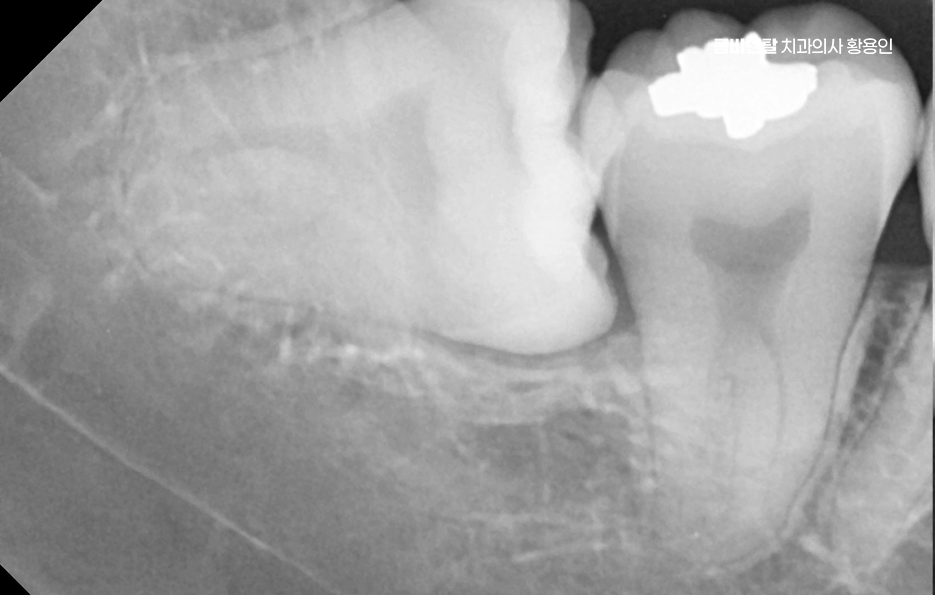 How to Systematically Prepare for Wisdom Tooth Extraction Due to Cavities image 7