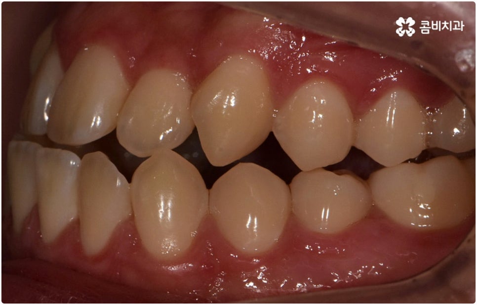 부정교합 3급 고치는 방법은 관련 이미지 5