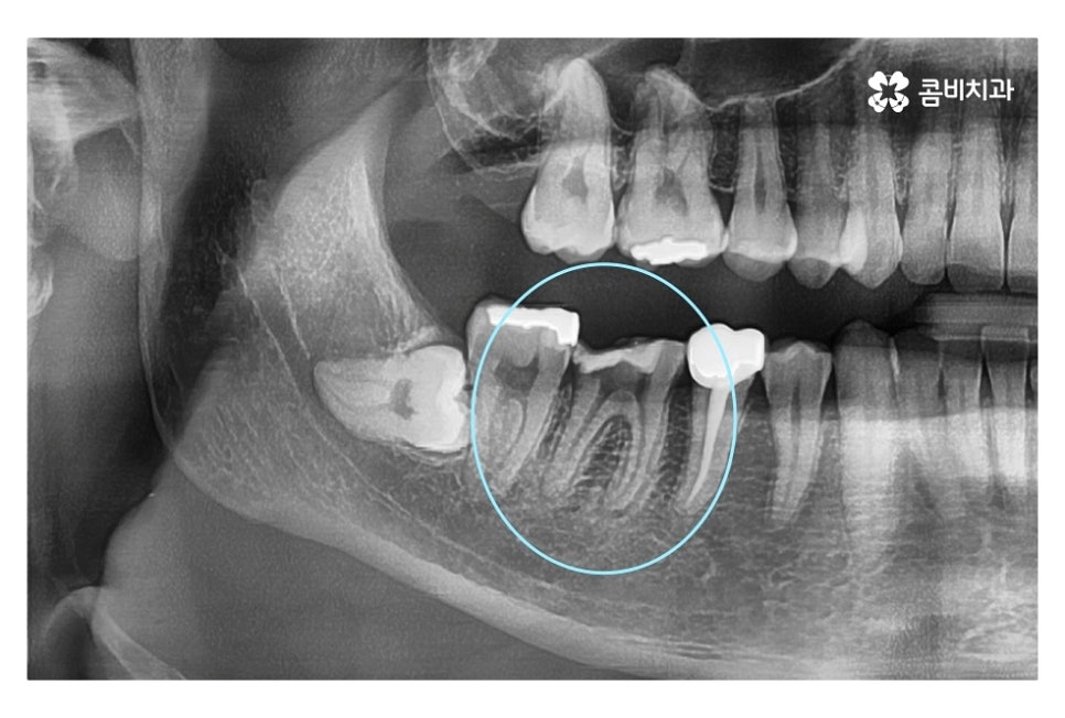 신경치료 후 크라운 시기를 놓치지 않으려면 관련 이미지 2