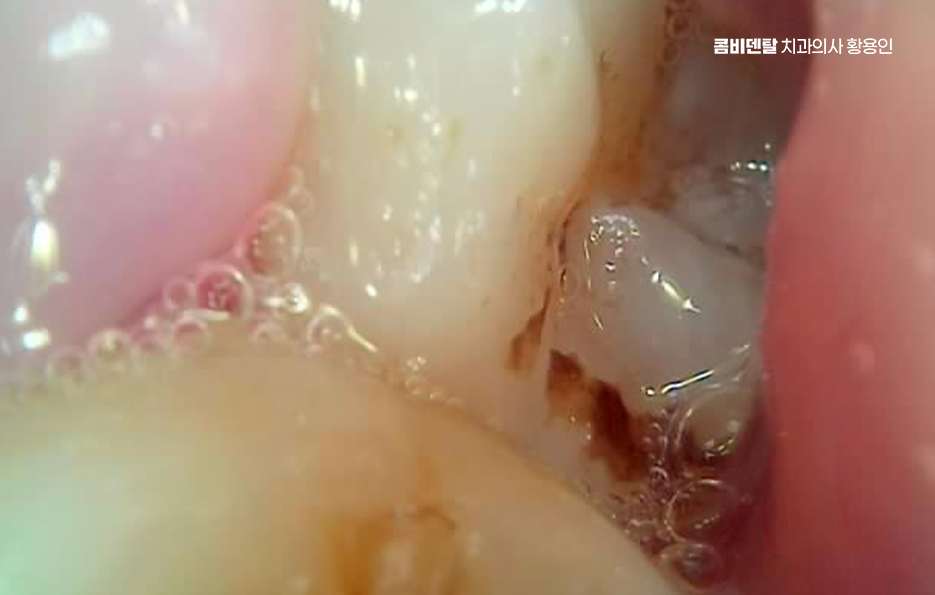 사랑니 주변 잇몸 통증 지금부터가 중요하니까 관련 이미지 3