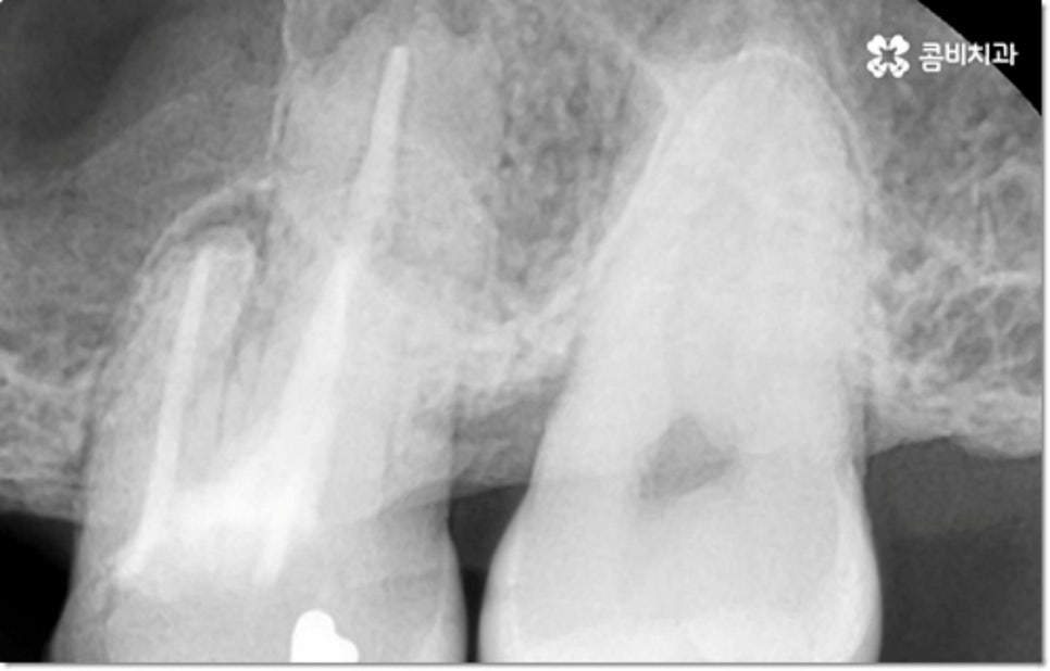 아랫니임플란트 주의할것들은? 관련 이미지 10