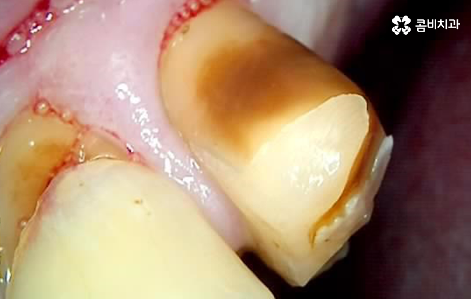 치주염 발치 이렇게나 심각하네요 관련 이미지 2