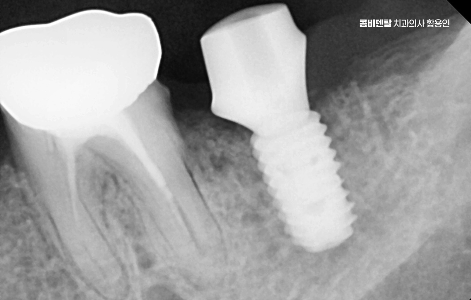 치아 발치 후 임플란트 언제부터 준비할까 관련 이미지 10