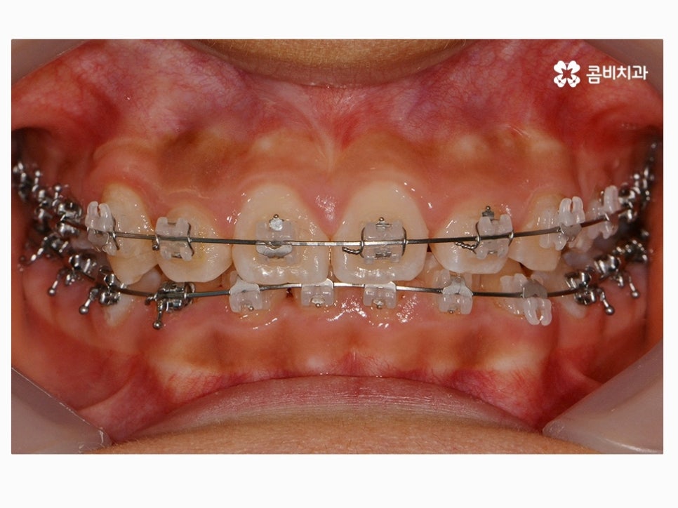 과개교합교정 어릴때 고쳐주면 좋은 사례 관련 이미지 8