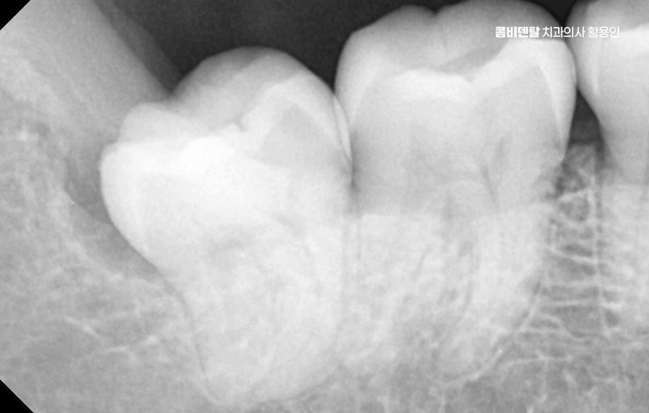 아래 사랑니 발치 통증 미리 알고 대처하려면 관련 이미지 6