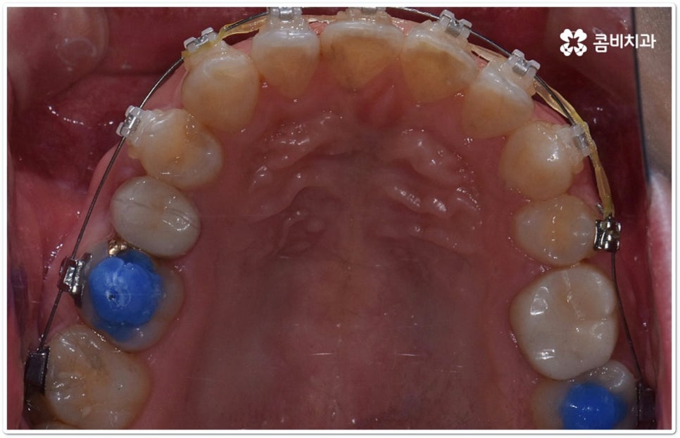 클리피씨교정 합리적인 초이스! 관련 이미지 7