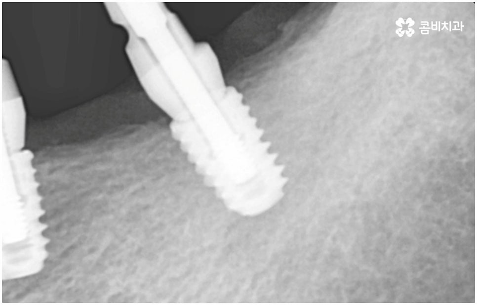발치후 임플란트 바로 되나요? 관련 이미지 9