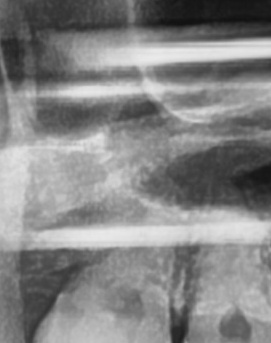 어금니 뒤 잇몸 부음 어떤 문제길래 이런거죠 관련 이미지 20