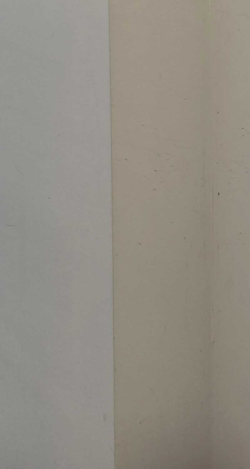 어금니 임플란트 과정 제대로 이해하려면 관련 이미지 19