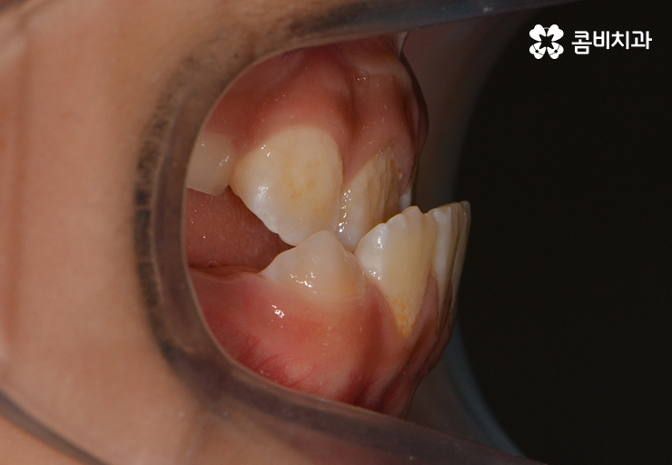 성장기치아교정 어떻게 접근하는 것이 좋을까 관련 이미지 3