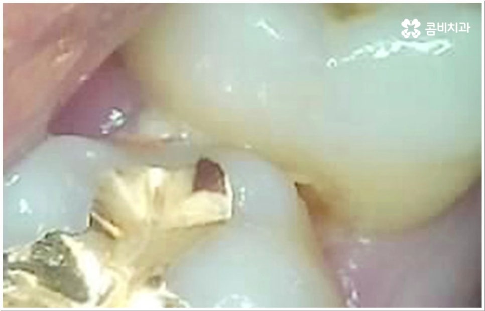 충치 통증 참지마세요 관련 이미지 6