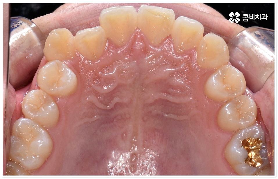 덧니치아교정 고려할 사항들은 관련 이미지 1